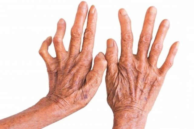 कर्णाली प्रदेशमा १ सय १४ कुष्ठरोगी भेटिए