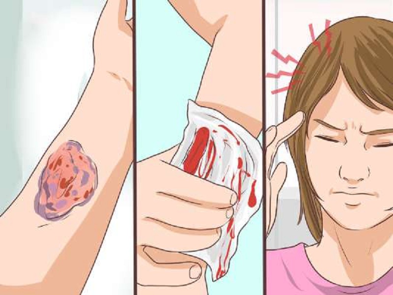 नेपालमा कति हिमोफिलियाका बिरामी छन्?