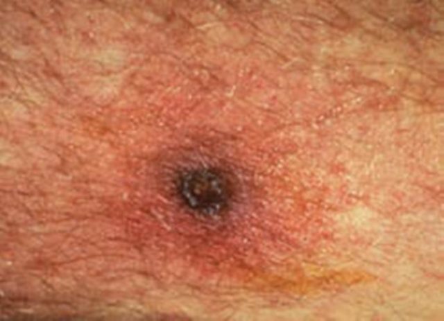 १६५ जनामा स्क्रब टाइफस