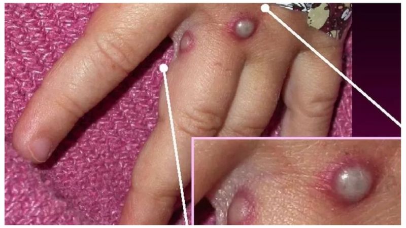 क्यानडामा ४७७ जनामा मङ्कीपक्स सङ्क्रमण पुष्टि